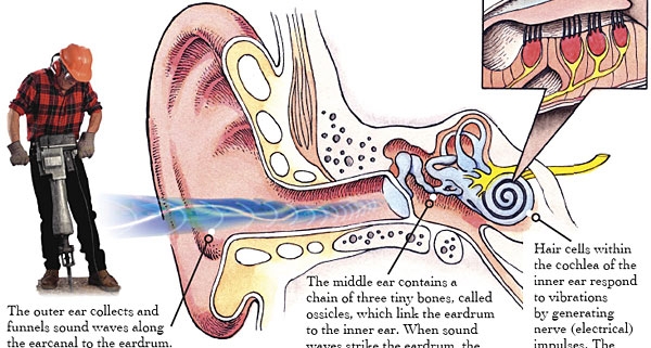 Hearing Loss in Factory Workers
